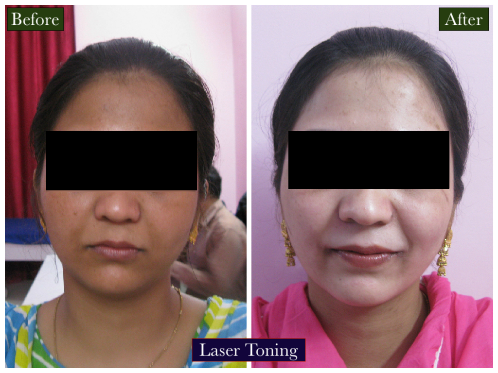 Laser Toning Treatment